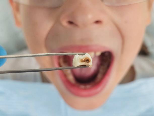 Best Emergency Root Canal Treatment in Cross Mountain, TX