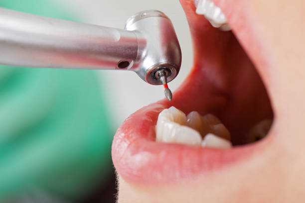 Best Broken or Cracked Tooth Emergency Dentist in Cross Mountain, TX